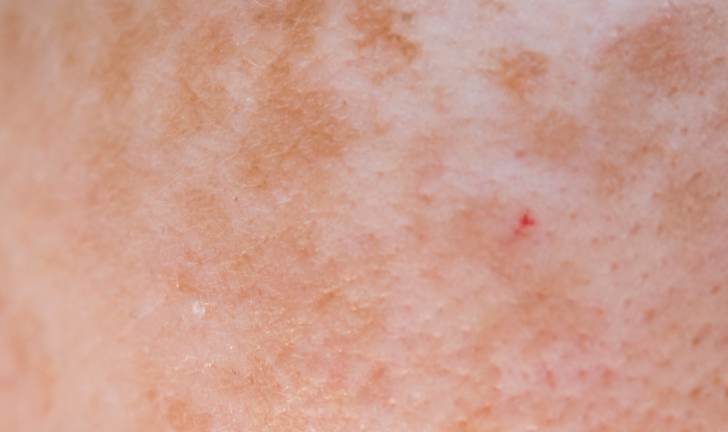 Macchie cutanee dopo il sole: come prevenirle