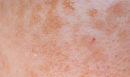 Macchie cutanee dopo il sole: come prevenirle